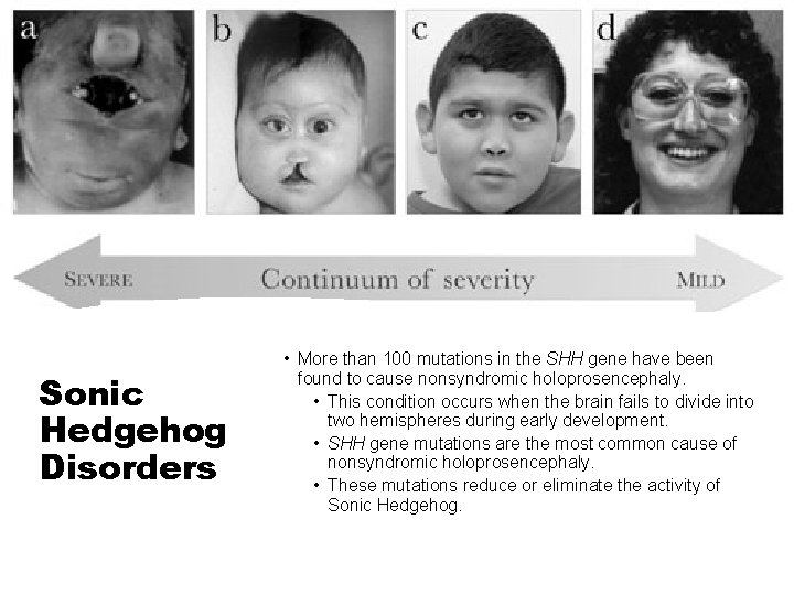 Sonic Hedgehog Disorders • More than 100 mutations in the SHH gene have been