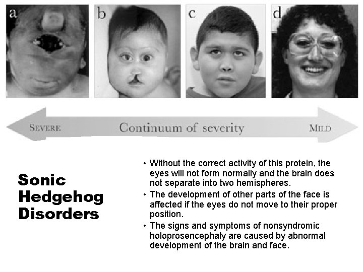 Sonic Hedgehog Disorders • Without the correct activity of this protein, the eyes will