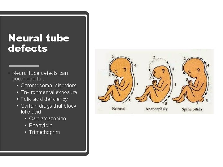 Neural tube defects • Neural tube defects can occur due to… • Chromosomal disorders