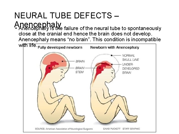 NEURAL TUBE DEFECTS – Anencephaly • Anencephaly is the failure of the neural tube