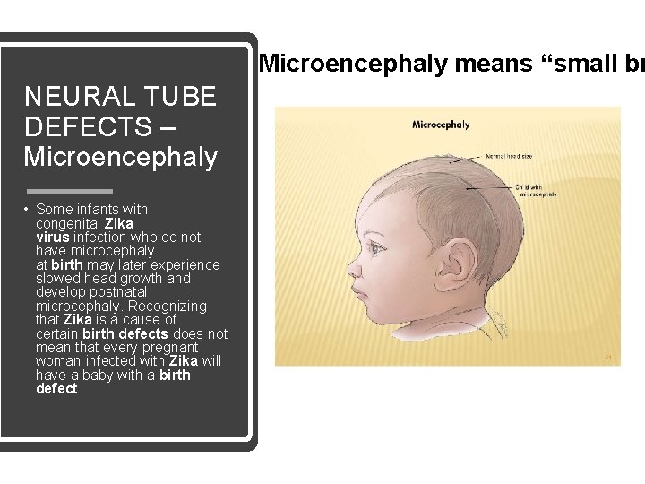 Microencephaly means “small br NEURAL TUBE DEFECTS – Microencephaly • Some infants with congenital