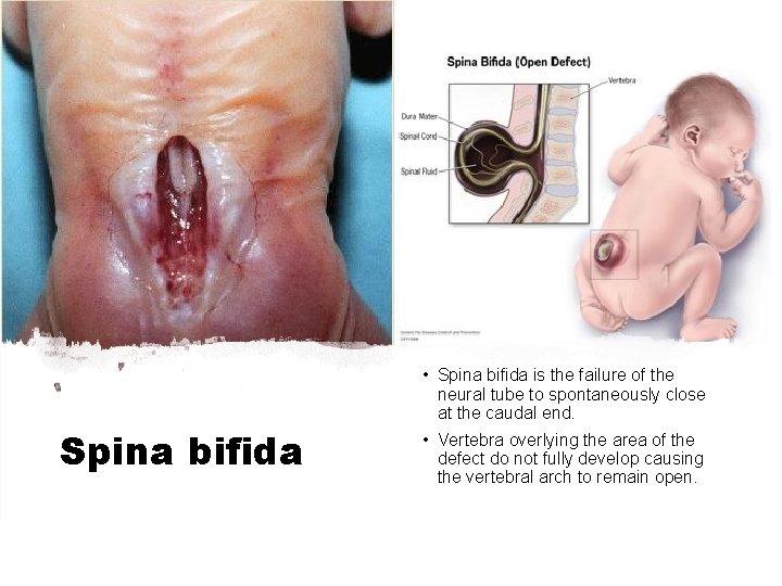  • Spina bifida is the failure of the neural tube to spontaneously close