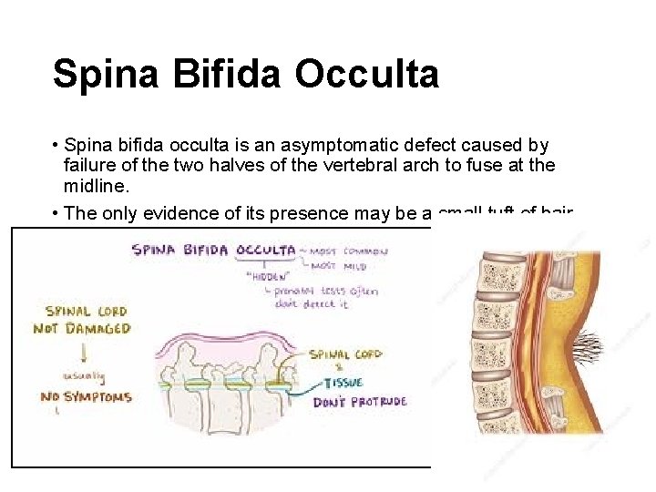 Spina Bifida Occulta • Spina bifida occulta is an asymptomatic defect caused by failure