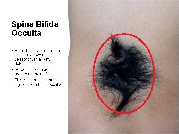 Spina Bifida Occulta • A hair tuft is visible on the skin just above