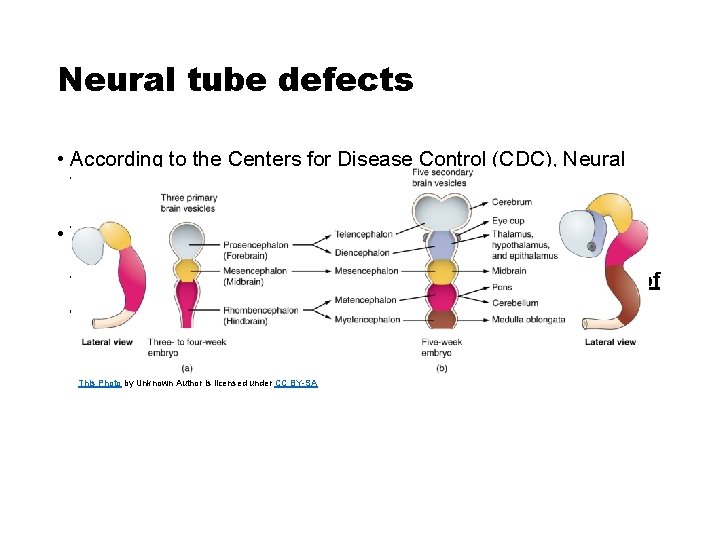 Neural tube defects • According to the Centers for Disease Control (CDC), Neural tube