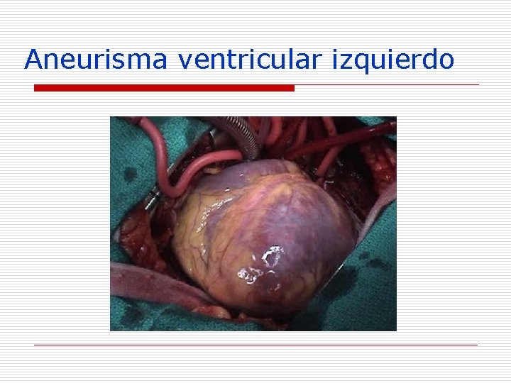 Aneurisma ventricular izquierdo 