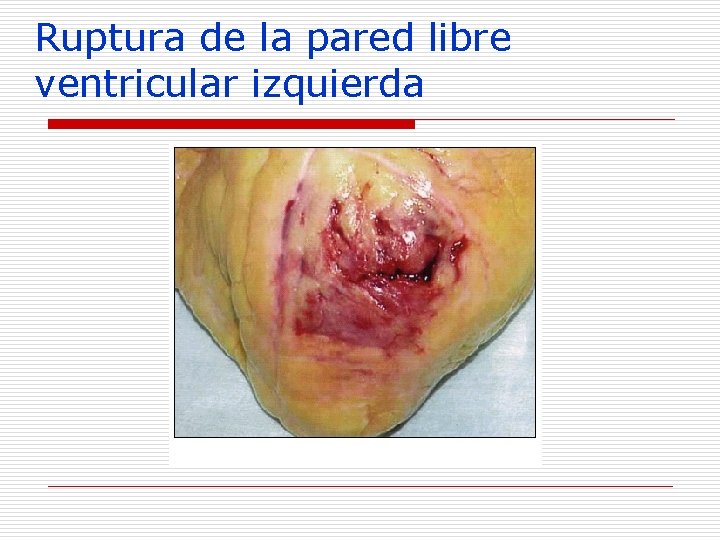 Ruptura de la pared libre ventricular izquierda 