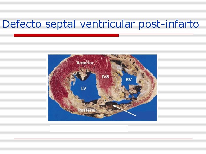 Defecto septal ventricular post-infarto 