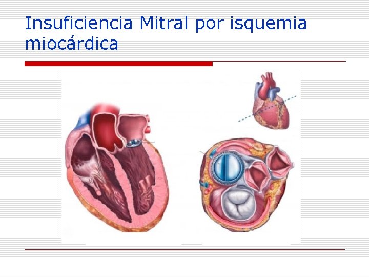 Insuficiencia Mitral por isquemia miocárdica 