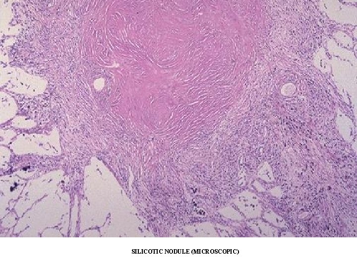 SILICOTIC NODULE (MICROSCOPIC) SILICOTIC NODULE (MICROSCOPIC)