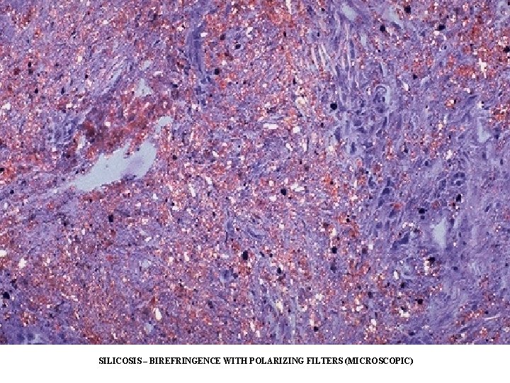 SILICOSIS – BIREFRINGENCE WITH POLARIZING FILTERS (MICROSCOPIC) SILICOSIS – BIREFRINGENCE WITH POLARIZING FILTERS (MICROSCOPIC)