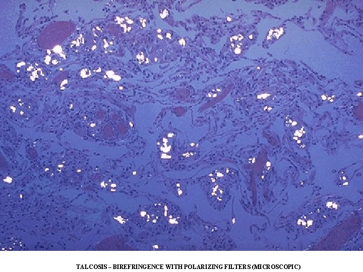 TALCOSIS – BIREFRINGENCE WITH POLARIZING FILTERS (MICROSCOPIC) TALCOSIS – BIREFRINGENCE WITH POLARIZING FILTERS (MICROSCOPIC)