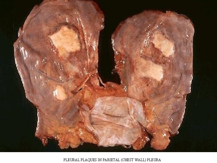PLEURAL PLAQUES IN PARIETAL (CHEST WALL) PLEURA PLEURAL PLAQUES IN PARIETAL (CHEST WALL) PLEURA