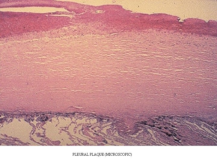 PLEURAL PLAQUE (MICROSCOPIC) PLEURAL PLAQUE (MICROSCOPIC)