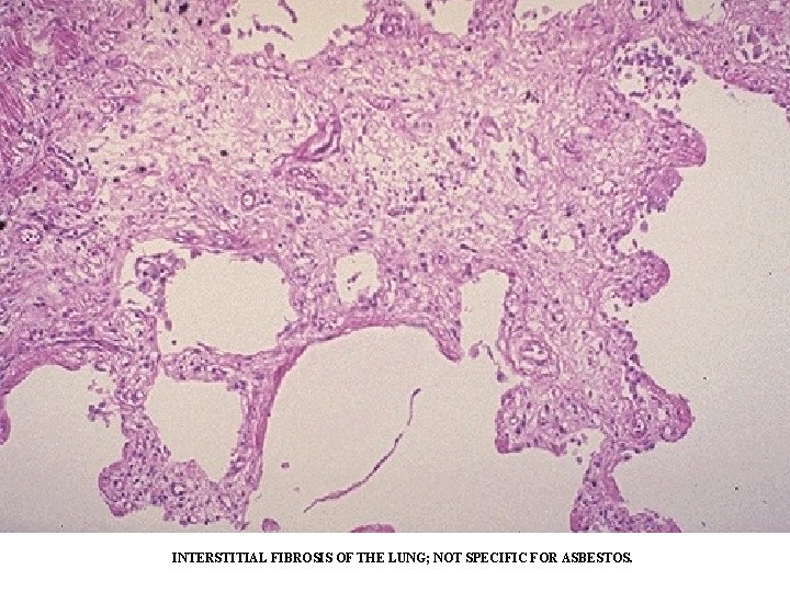 INTERSTITIAL FIBROSIS OF THE LUNG; NOT SPECIFIC FOR ASBESTOS. INTERSTITIAL FIBROSIS OF THE LUNG; NOT SPECIFIC FOR ASBESTOS.