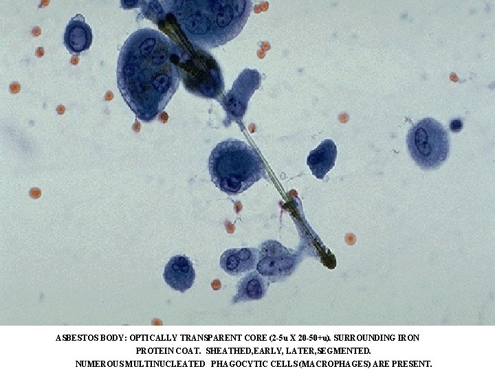 ASBESTOS BODY: OPTICALLY TRANSPARENT CORE (2 -5 u X 20 -50+u). SURROUNDING IRON PROTEIN ASBESTOS BODY: OPTICALLY TRANSPARENT CORE (2 -5 u X 20 -50+u). SURROUNDING IRON PROTEIN