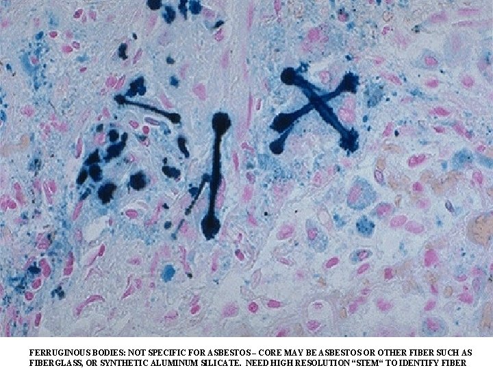 FERRUGINOUS BODIES: NOT SPECIFIC FOR ASBESTOS – CORE MAY BE ASBESTOS OR OTHER FIBER FERRUGINOUS BODIES: NOT SPECIFIC FOR ASBESTOS – CORE MAY BE ASBESTOS OR OTHER FIBER