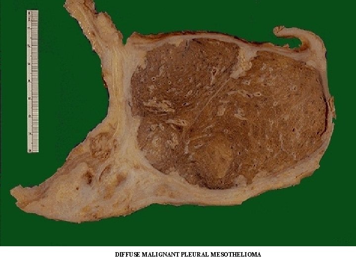 mesothelioma supportive treatment