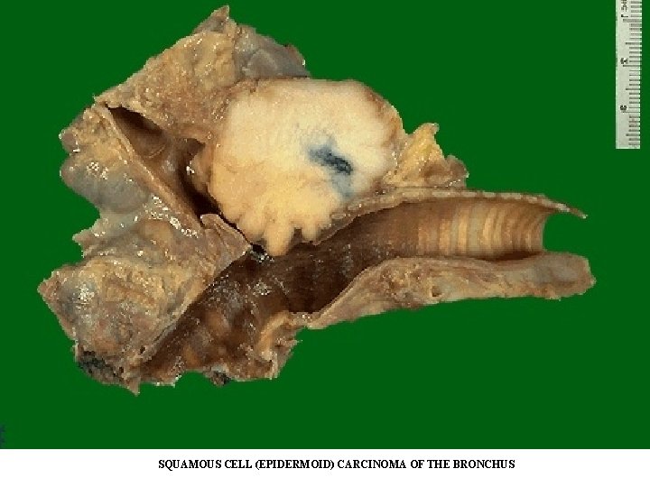 SQUAMOUS CELL (EPIDERMOID) CARCINOMA OF THE BRONCHUS SQUAMOUS CELL (EPIDERMOID) CARCINOMA OF THE BRONCHUS