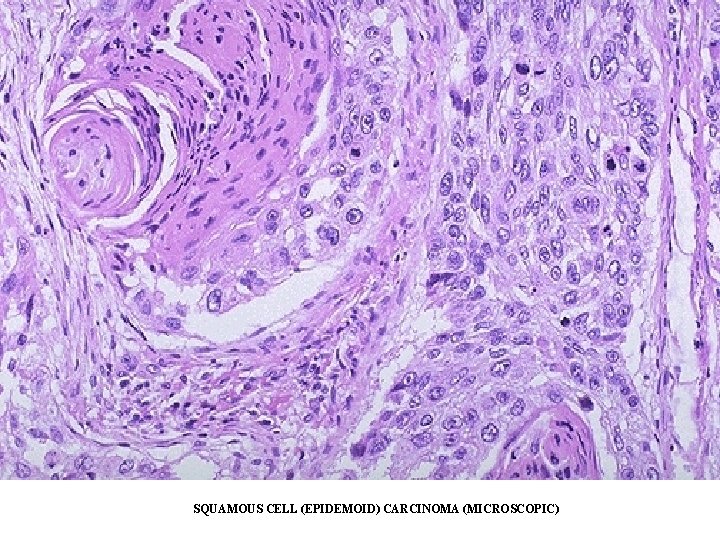 SQUAMOUS CELL (EPIDEMOID) CARCINOMA (MICROSCOPIC) SQUAMOUS CELL (EPIDEMOID) CARCINOMA (MICROSCOPIC)
