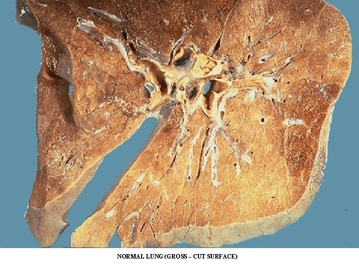 NORMAL LUNG (GROSS – CUT SURFACE) NORMAL LUNG (GROSS – CUT SURFACE)