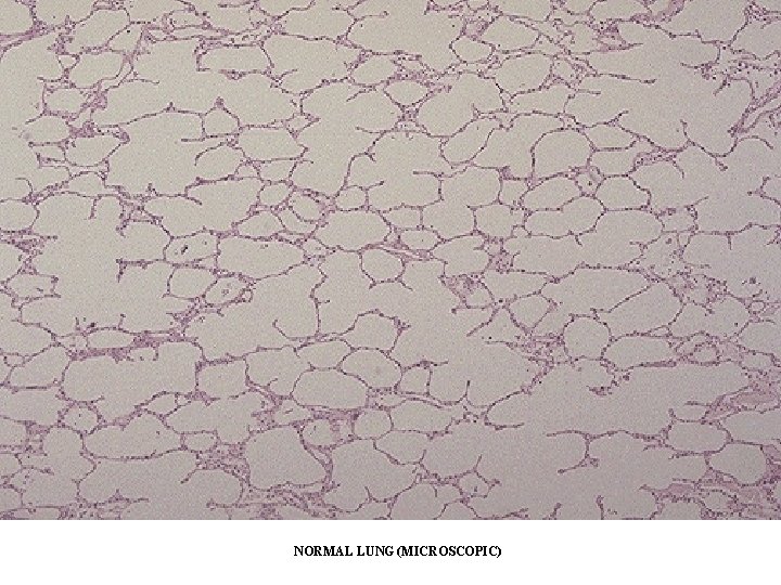 NORMAL LUNG (MICROSCOPIC) NORMAL LUNG (MICROSCOPIC)