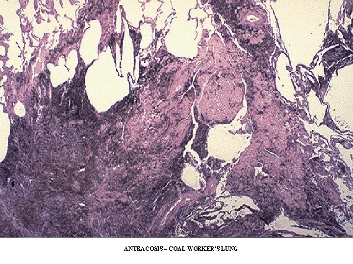 ANTRACOSIS – COAL WORKER’S LUNG ANTRACOSIS – COAL WORKER’S LUNG