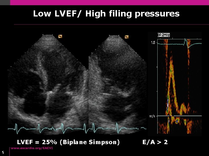 Low LVEF/ High filing pressures LVEF = 25% (Biplane Simpson) 5 E/A > 2 Low LVEF/ High filing pressures LVEF = 25% (Biplane Simpson) 5 E/A > 2