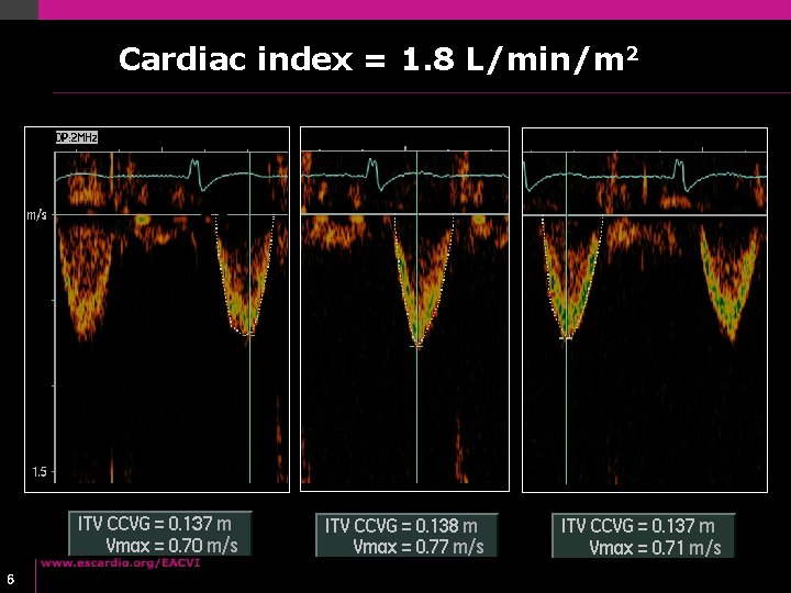 Cardiac index = 1. 8 L/min/m 2 6 Cardiac index = 1. 8 L/min/m 2 6