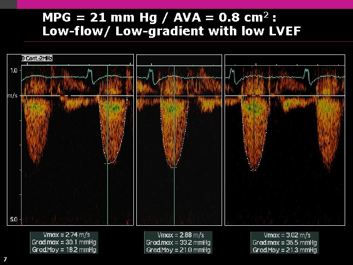 MPG = 21 mm Hg / AVA = 0. 8 cm 2 : Low-flow/ MPG = 21 mm Hg / AVA = 0. 8 cm 2 : Low-flow/