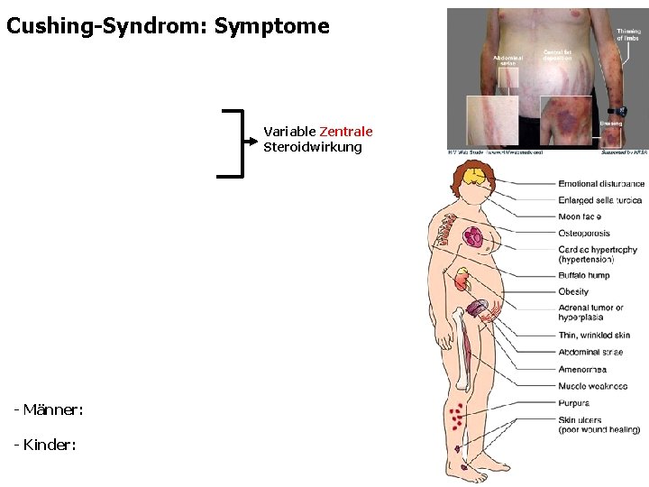 Cushing-Syndrom: Symptome Variable Zentrale Steroidwirkung - Männer: - Kinder: 