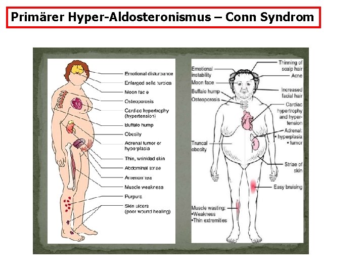 Primärer Hyper-Aldosteronismus – Conn Syndrom 