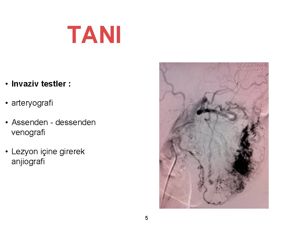 TANI • Invaziv testler : • arteryografi • Assenden - dessenden venografi • Lezyon