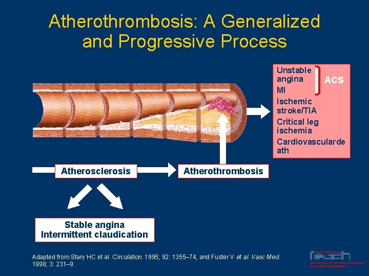 Atherothrombosis: A Generalized and Progressive Process Unstable angina ACS MI Ischemic stroke/TIA Critical leg