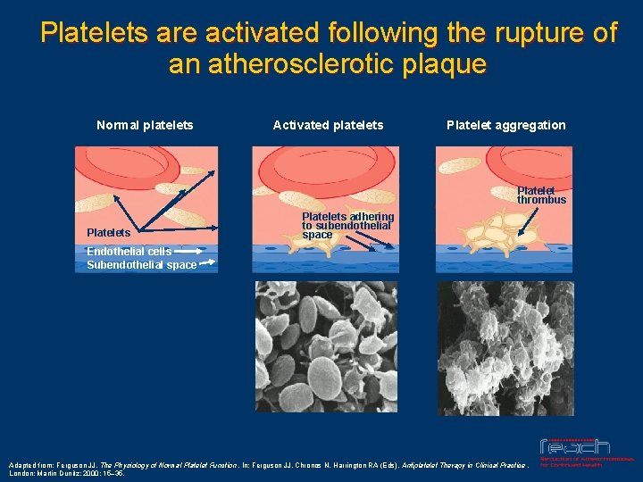 Platelets are activated following the rupture of an atherosclerotic plaque Normal platelets Activated platelets