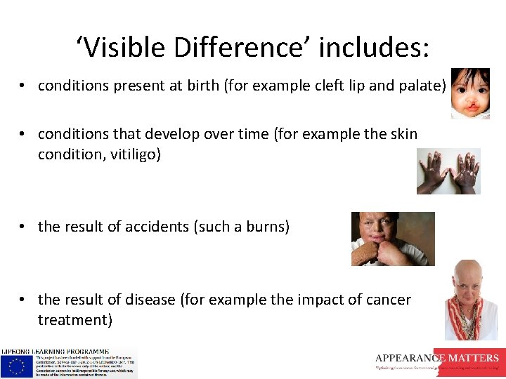 ‘Visible Difference’ includes: • conditions present at birth (for example cleft lip and palate)