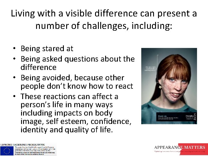 Living with a visible difference can present a number of challenges, including: • Being