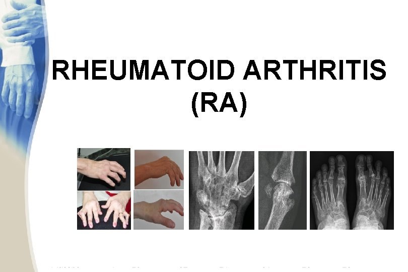 RHEUMATOID ARTHRITIS (RA) 