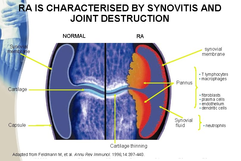 RA IS CHARACTERISED BY SYNOVITIS AND JOINT DESTRUCTION NORMAL RA Inflamed synovial membrane Synovial