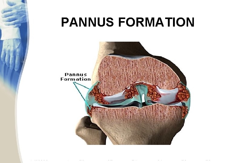 PANNUS FORMATION 