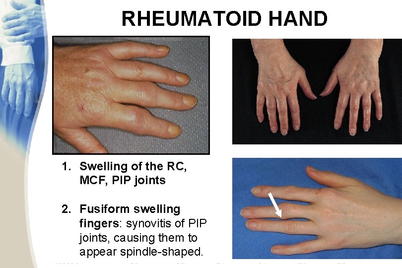 RHEUMATOID HAND 1. Swelling of the RC, MCF, PIP joints 2. Fusiform swelling fingers: