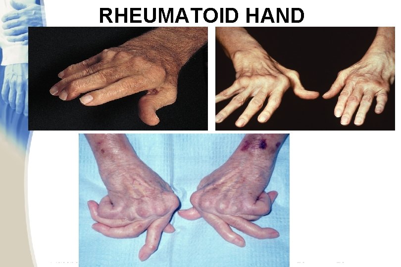 RHEUMATOID HAND 