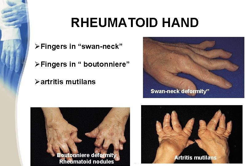 RHEUMATOID HAND ØFingers in “swan-neck” ØFingers in “ boutonniere” Øartritis mutilans Swan-neck deformity” DEGETE