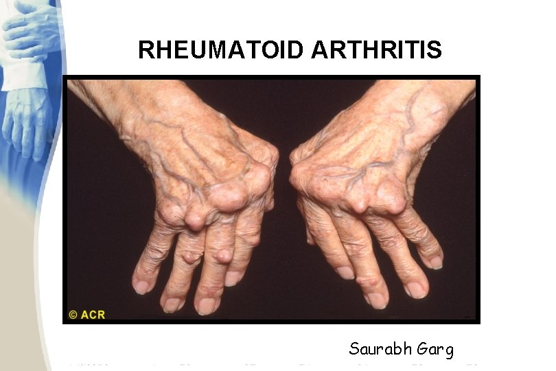 RHEUMATOID ARTHRITIS Saurabh Garg 