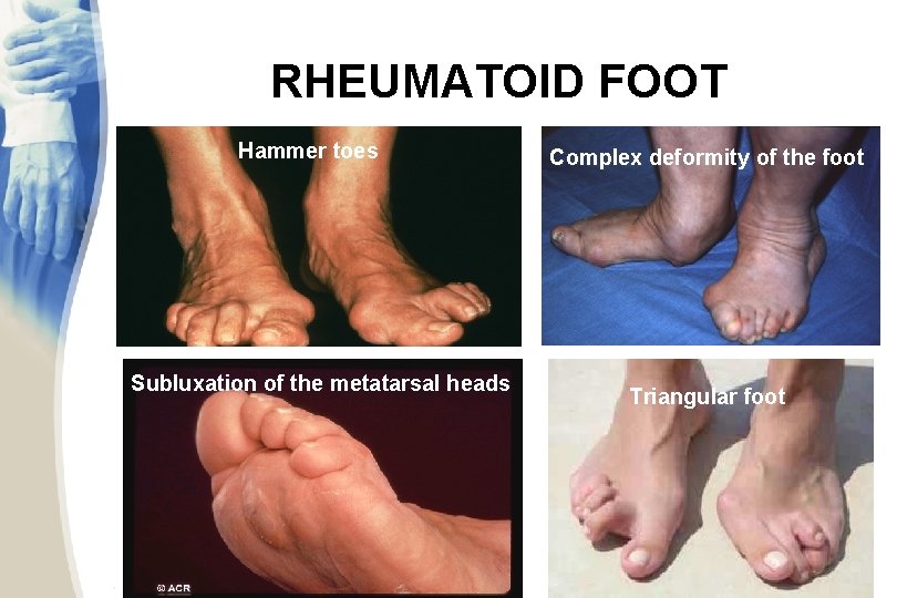 RHEUMATOID FOOT Hammer toes Subluxation of the metatarsal heads Complex deformity of the foot