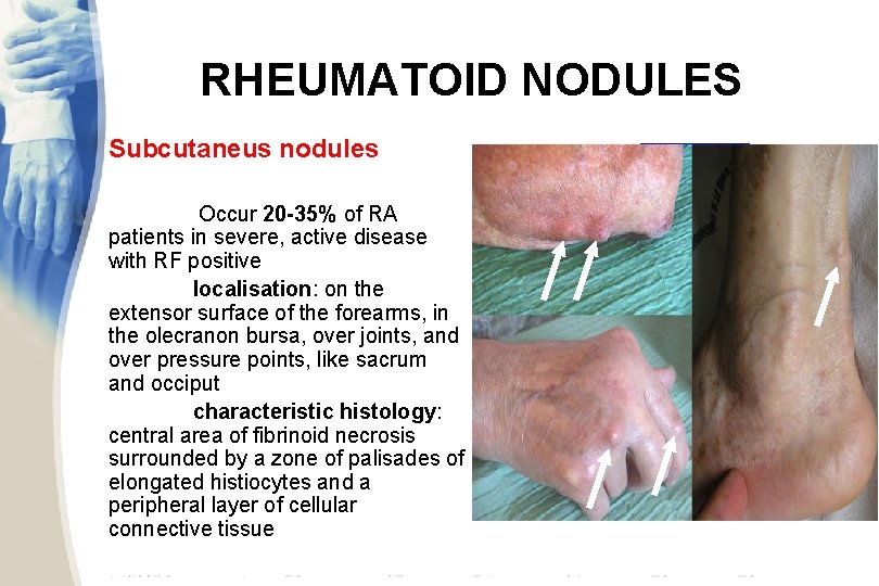RHEUMATOID NODULES Subcutaneus nodules Occur 20 -35% of RA patients in severe, active disease