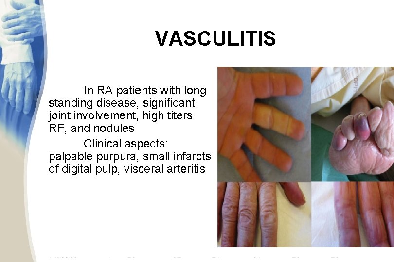 VASCULITIS In RA patients with long standing disease, significant joint involvement, high titers RF,