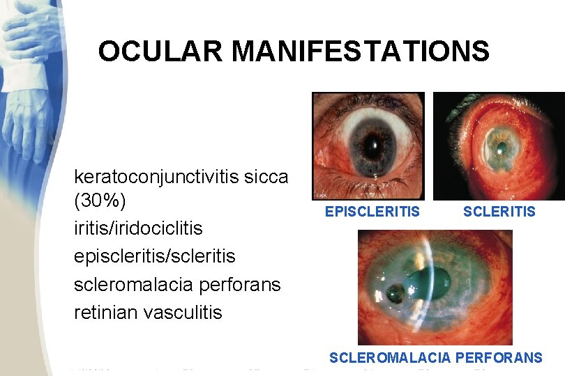 OCULAR MANIFESTATIONS keratoconjunctivitis sicca (30%) iritis/iridociclitis episcleritis/scleritis scleromalacia perforans retinian vasculitis EPISCLERITIS SCLEROMALACIA PERFORANS