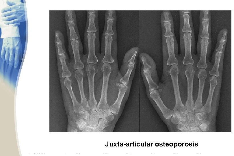 Juxta-articular osteoporosis 