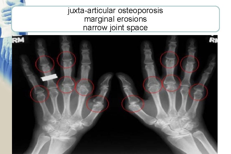 juxta-articular osteoporosis marginal erosions narrow joint space 